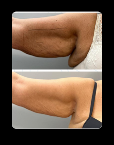 Resultado Braços