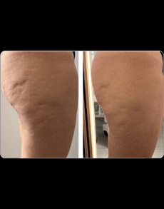 Resultado Coxas